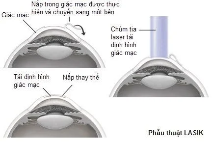 viễn thị