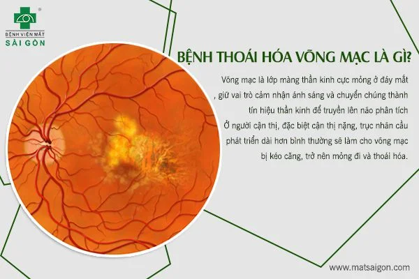 Thoái hóa võng mạc do cận thị, nên điều trị thế nào?