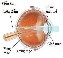 viễn thị