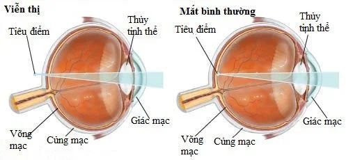 viễn thị